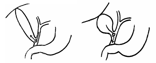 借助腹壁呼吸運(yùn)動促使膽汁進(jìn)出膽囊